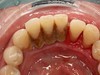 祛除顽固牙菌斑  XWAVES小蛮腰冲牙器效果实测