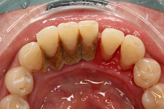 祛除顽固牙菌斑  XWAVES小蛮腰冲牙器效果实测
