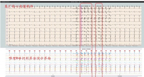 医疗级12导联心电图算法