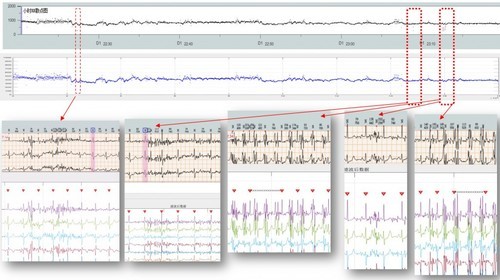 医疗级12导联心电图算法