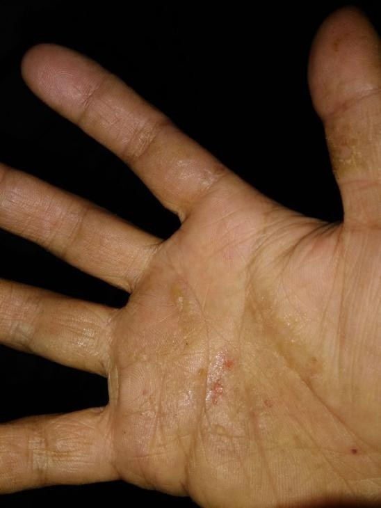 手上长湿疹,怎么治好得快