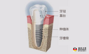 牙齿缺失如何选择最佳的修复方式