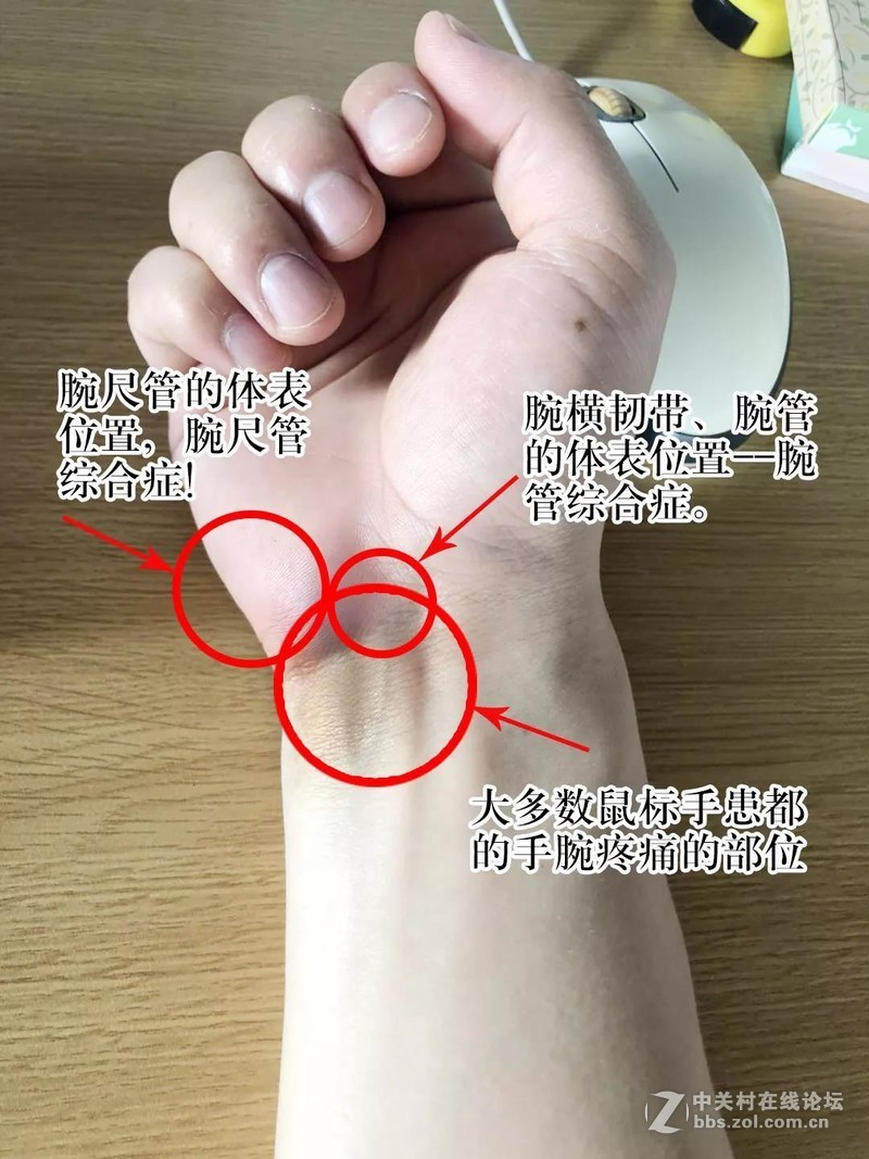 鼠标手患者用了人体工程学鼠标手还痛？可能是使用姿势有问题