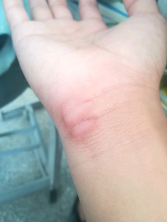 鼠标手患者用了人体工程学鼠标手还痛？可能是使用姿势有问题