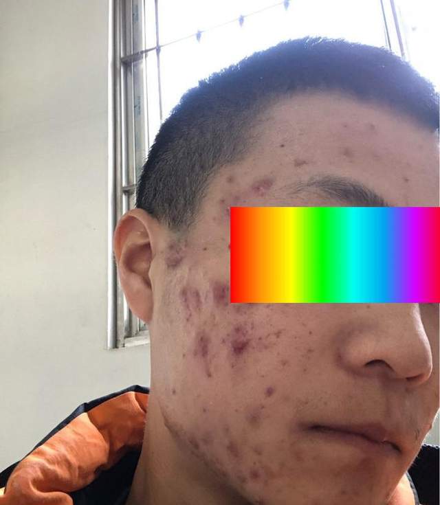 痘战圣佛告诉你，这样祛痘更快更安全