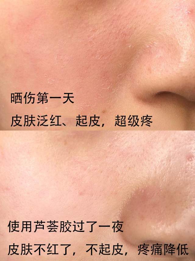 痘战圣佛告诉你，这样祛痘更快更安全