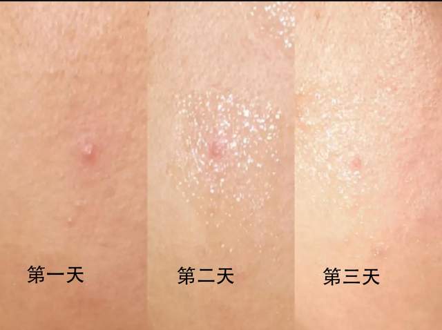 痘战圣佛告诉你，这样祛痘更快更安全