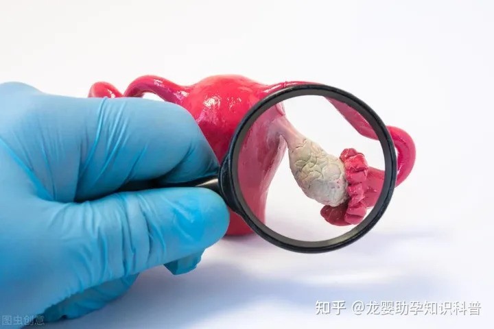 多囊卵巢综合征患者能自然怀孕吗？一定要做试管吗