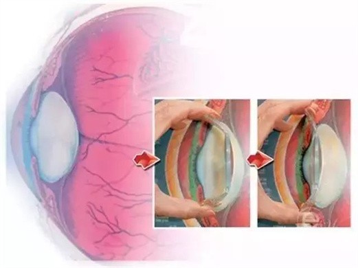 “暑假眼睛度数增加100度， 马上接近400度了！”为什么孩子近视会激增呢？