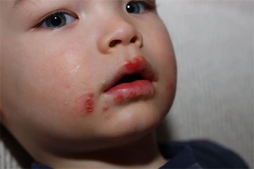 宝宝上火危害大，易引发七种疾病！get好清火方，爸妈心不慌！