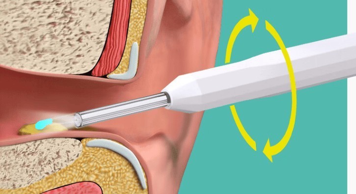 可视耳勺到底好不好用？选购必备六大攻略分享！