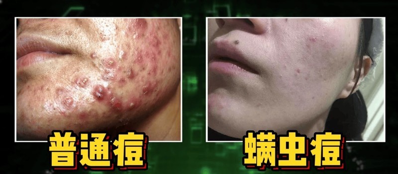 除螨仪是否真的能除螨？一文带你了解螨虫危害与选购要点全解析