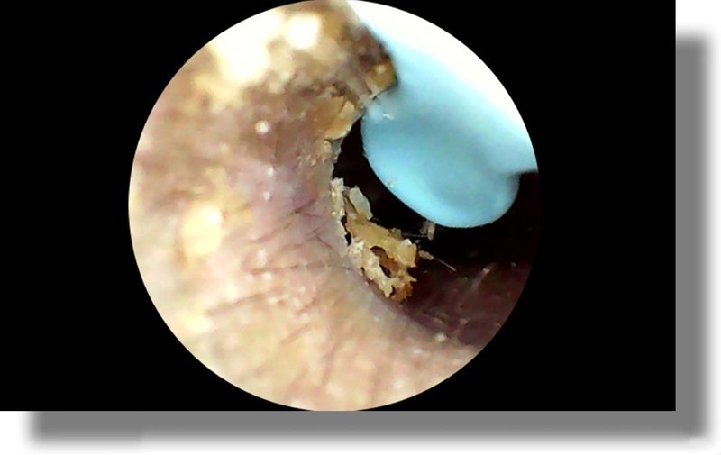 耳朵里的小世界你敢看吗？智能可视掏耳勺让你看清耳屎！