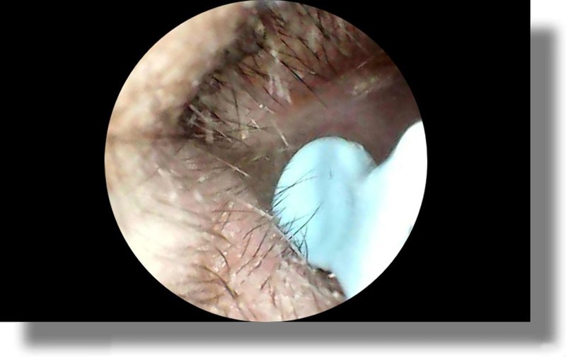 耳朵里的小世界你敢看吗？智能可视掏耳勺让你看清耳屎！