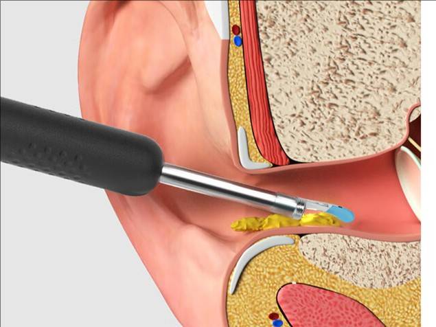 儿童耳勺买什么牌子？顶尖可视挖耳勺一目了然！